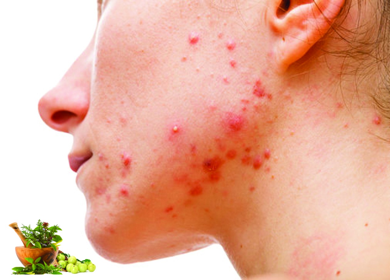 Panchakarma Treatment For Acne