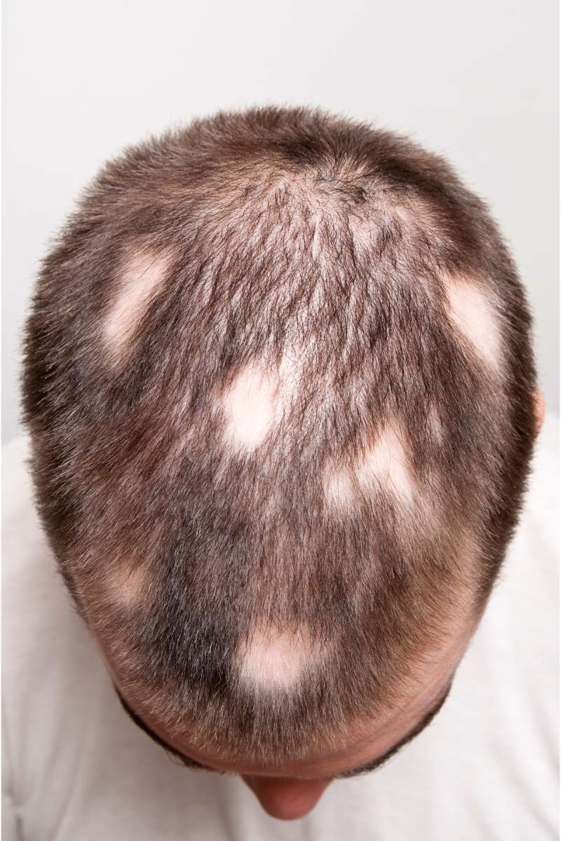 Ayurvedic Panchakarma Treatment Alopecia Areata