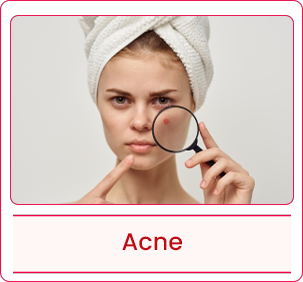 Acne-wh.png