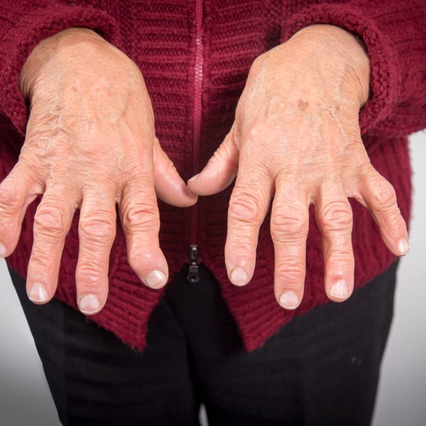 639586709-rheumatoid-arthritis